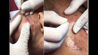 Best Pimple Popping 14 beautiful blackheads sacdepspa [upl. by Ennair578]