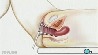 PreOp® Dilation and Curettage D amp C Surgery [upl. by Kan]