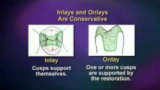 V1529  Esthetic Alternatives for Crowns  ToothColored Inlays and Onlays [upl. by Alilad216]