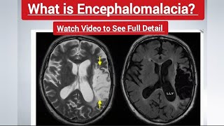 What is Encephalomalacia Full Details here  MRIBRAIN brainstroke infarct CtScanBrain MRI CT [upl. by Adnahsam946]