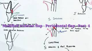 Modified widman flap Periodontal flap  Part  4 [upl. by Anahsor]