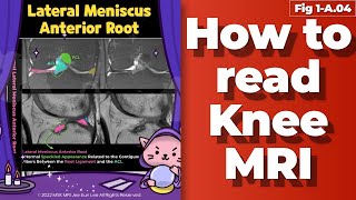 Fig 1A04 Anatomy of lateral Meniscus anterior root tibial spine fracture [upl. by Aivatra]