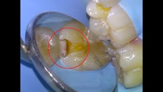 22 Dental filling for decay between teeth [upl. by Orella]