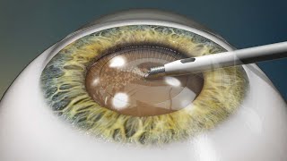 Dr Jon Weyer explains Refractive Lens Exchange [upl. by Cordy]