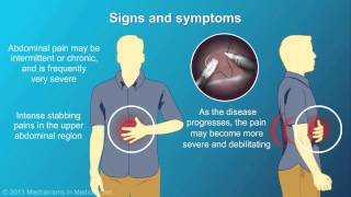 Chronic Pancreatitis [upl. by Vogele]