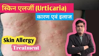 Skin Allergy Urticaria Cause And Treatment in Hindi  पित्ती का इलाज [upl. by Eitsym]