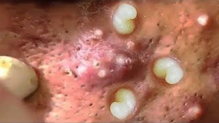 Part 07  Acne Vulgaris and Extracting large Whiteheads [upl. by Agnizn498]