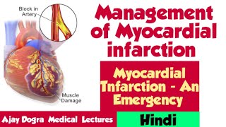 Management of Myocardial Infarction  AN EMERGENCY  KD TRIPATHI  MBBS  BAMS  HINDI [upl. by Silma]