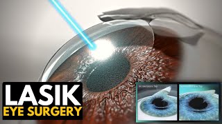 Lasik Eye Surgery Everything You Need to Know [upl. by Delaryd244]