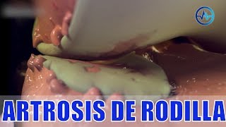 ARTROSIS de RODILLA 🦵 DESGASTE de CARTÍLAGO 🦿 NEOMEDICA  MEDICINA EXTRAORDINARIA [upl. by Dixon417]