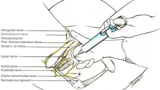 Best location to deliver anaesthetic to perform pudendal nerve block [upl. by Grenier649]