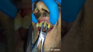 Tooth Extraction dentist tooth extraction dentistry shortsfeed shorttrending shortviral [upl. by Tolmann]