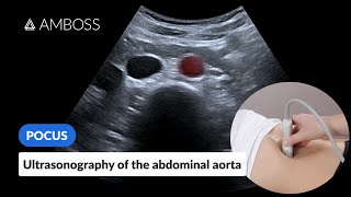 Point of Care Ultrasound of the Abdominal Aorta  AMBOSS Video [upl. by Huntley]