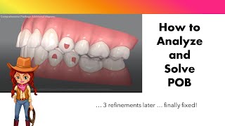 Invisalign ClinCheck  End the struggle with Posterior Open Bite [upl. by Sherard]