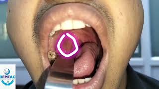 Tonsillolith or Tonsil stone removal tonsilstones tonsils entsurgeon entsurgeondelhi entdoctor [upl. by Kosel]