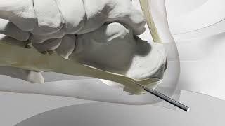 Minimally Invasive Plantar Fasciitis Heel Spur Surgery [upl. by Hi531]