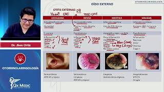 OTORRINOLARINGOLOGÍA Oído externo Otitis externas [upl. by Iredale]