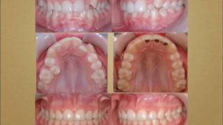 Cas traités en orthodontie orthodontistes Lemaymov [upl. by Hort251]