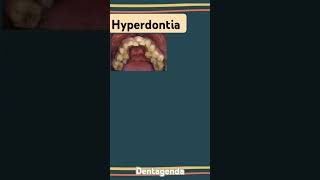 Hyperdontia [upl. by Epps]