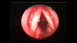 Endoscopic View of Vocal cords [upl. by Aleacin]