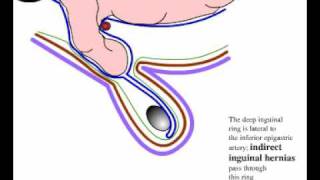 Direct and indirect inguinal hernia [upl. by Fachan]