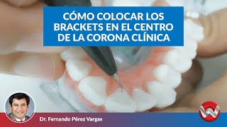 Cómo colocar los brackets en el centro de la corona clínica [upl. by Letniuq]