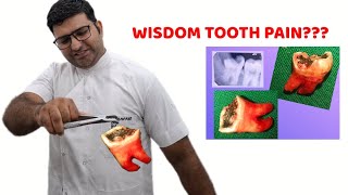 Wisdom Tooth Impacted third Molar Treatment of Pain in wisdom tooth Akal Daadh ka ilaaj [upl. by Weide]