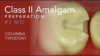 Class II Amalgam Preparation 3 MO [upl. by Mcgaw]