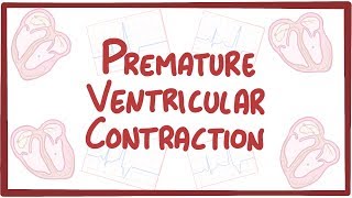 Premature Ventricular Contraction  causes symptoms diagnosis treatment pathology [upl. by Eissej354]