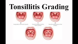 Tonsillitis Grading [upl. by Laven]