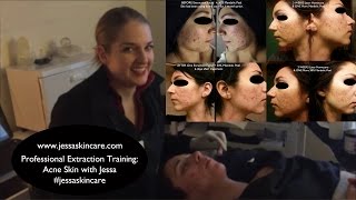 Acne Treatment Extraction Facial Pimple Blackhead Extractions  Esthetician School [upl. by Lerud323]