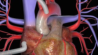 Cirurgia de Revascularização do Miocárdio CRM [upl. by Luwana]