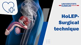 ANIMATION  Holmium Laser Enucleation of the Prostate HoLEP – „3 horseshoe technique“ [upl. by Ettenahs282]