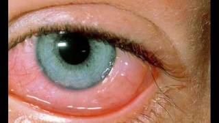 Conjuntivitis Alergica  ESPANOL [upl. by Jak]