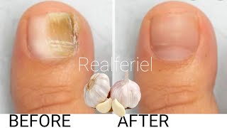 Soigner la mycose des ongles naturellement  Vous devez tester cette astuce [upl. by Drogin]