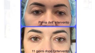 Intervento Blefaroplastica Superiore upperblepharoplasty blefaroplastica [upl. by Pat999]