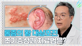 이게 대상포진 초기증상 72시간 골든타임이 중요한 이유｜건강노트 [upl. by Ahsilrak]