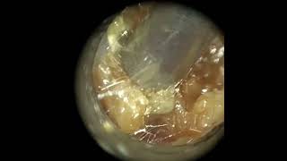 254  Fungal Infected Ear Wax Removal using the WAXscope®️ [upl. by Streetman743]