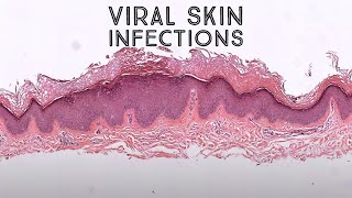 Viral Skin Infections amp Mimics Board Review for Dermpath Dermatology Pathology [upl. by Yttam226]