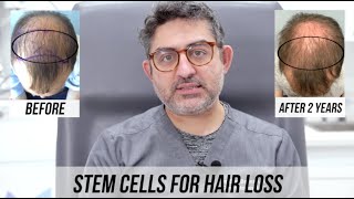 STEM CELL Hair Restoration 2 Year Update [upl. by Kappenne]