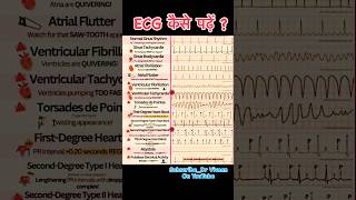 ECG Report  How To Read ECG  Abnormal ECG  Normal ECG 10millionviews trending ytshorts [upl. by Yezdnil956]