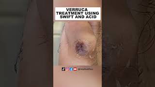 Wart or Verruca treatment Using swift and acid by Miss Foot Fixer Marion Yau [upl. by Orodisi]