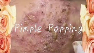 Pimple amp Blackheads Popping  8 [upl. by Animrac226]