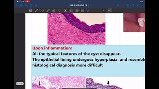 variant of okc and enucleation [upl. by Anitnegra]