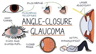 Understanding Acute Angle Closure Glaucoma [upl. by Elleb731]