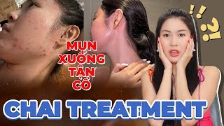 Mình đã trị sạch mụn nổi xuống tận cổ khi bị CHAI TREATMENT như thế nào ❗❓ [upl. by Yniatirb]