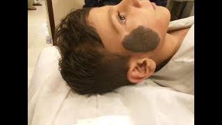 See the Change Live Laser Treatment for Birthmark Removal lasertreatment birthmarkremoval [upl. by Stuckey417]