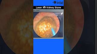 Kidney stone treatment using laser  RIRS  Retrograde intrarenal surgery shorts [upl. by Coughlin203]