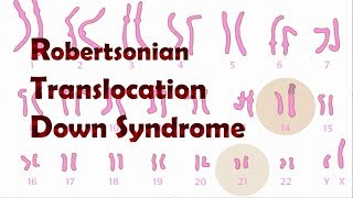 Robertsonian Translocation Down Syndrome ROB [upl. by Salomon490]