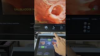 Gallbladder Polyp 3d Ultrasound [upl. by Kemeny]